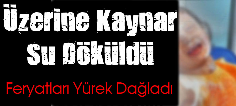 Üzerine Kaynar Su Döküldü