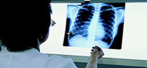 Isparta'da 54 Yeni Verem Hastası Var