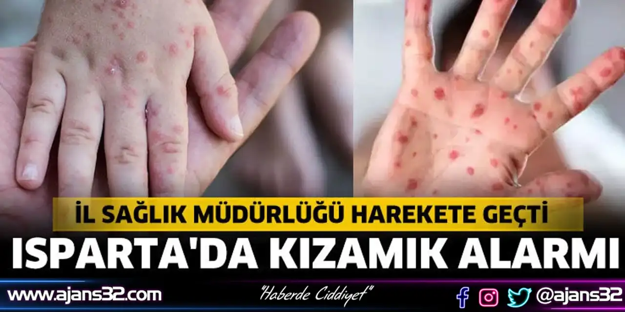 Isparta'da Kızamık Alarmı
