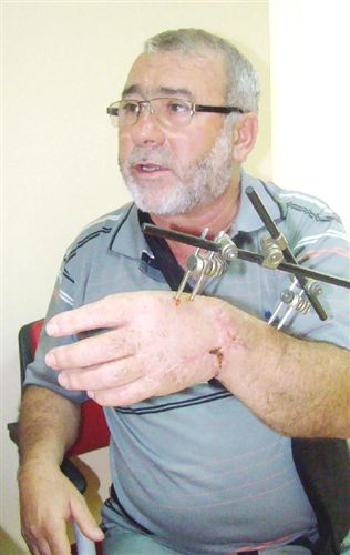 Kopma Noktasına Gelen Bileği, Yerine Dikildi