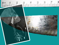 Boynundan 8 cm'lik Bıçak Çıkarttılar!